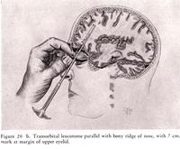 An illustration from the Freeman and Watts' book on "Psychosurgery". The leucotome was usually inserted via the inner canthus.